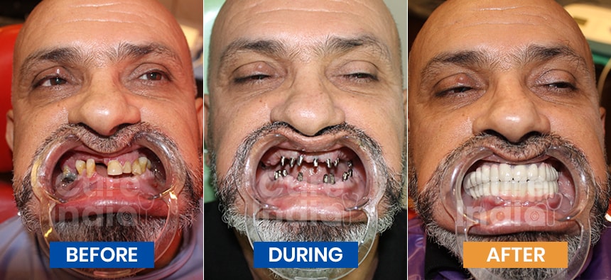 Dental implants before and after Case 4